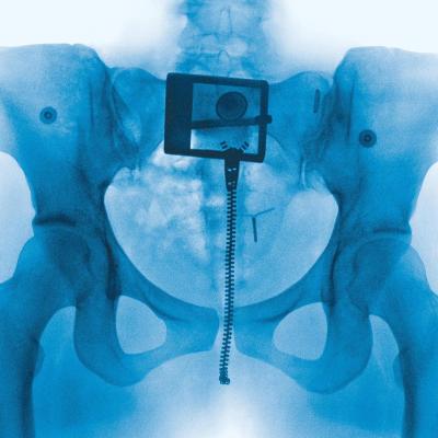 An X-ray of a pelvis with a visible belt buckle, zipper line, and IUD.